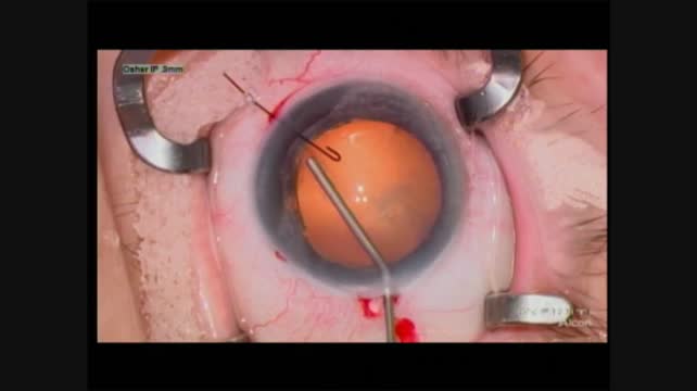 Iris and Zonular Dysgenesis