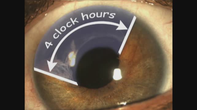 Secondary Iris Reconstruction 