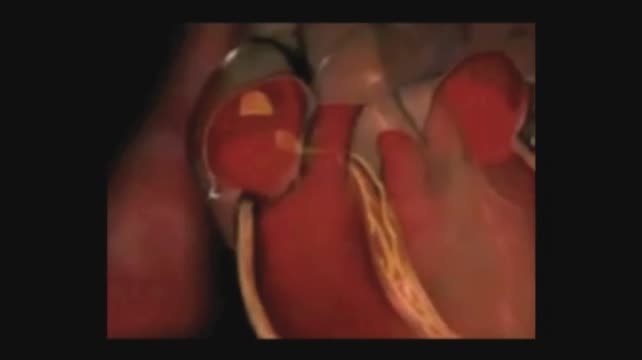 Pusatile Herniation of the Posterior Capsule 