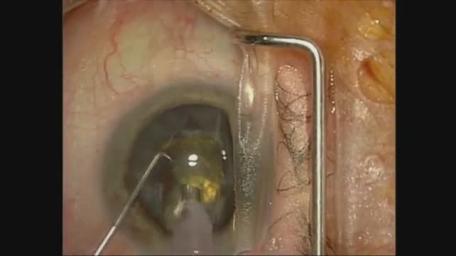 Intravitreal Devices and Posterior Capsule Damage 