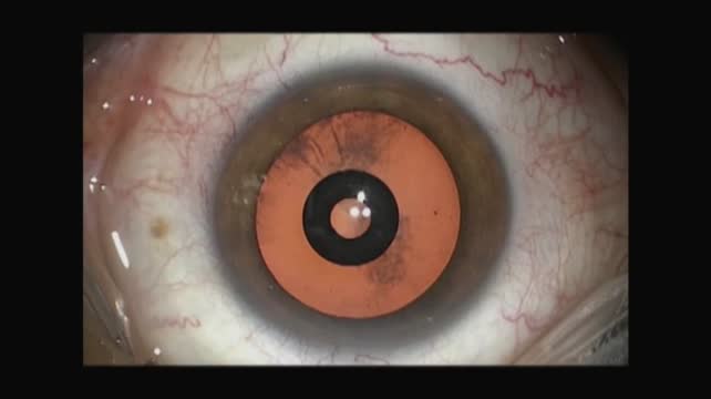 Corneal Inlay 