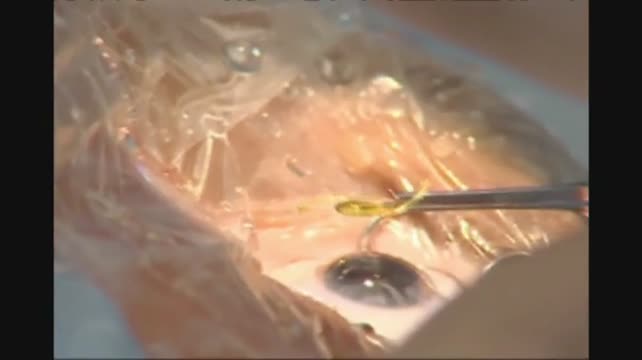 ReSTOR Toric / Tecnis Multifocal Toric 