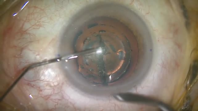 FlueVision Trifocal / AT Lisa Tritoric