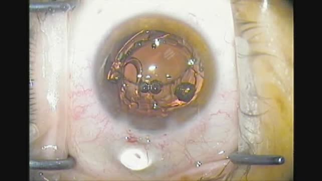 Dual Optic Accommodating 