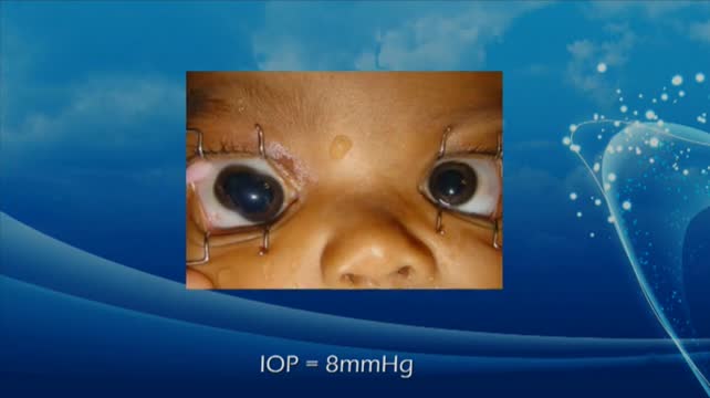 Management of the Double Crystalline Lens 