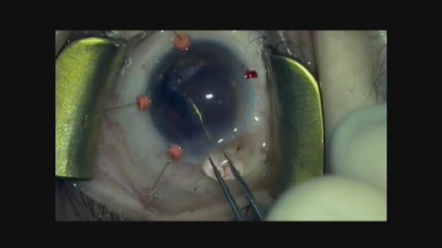 Telometric IOP Measurement: Deciphering Glaucoma's Blind Spot