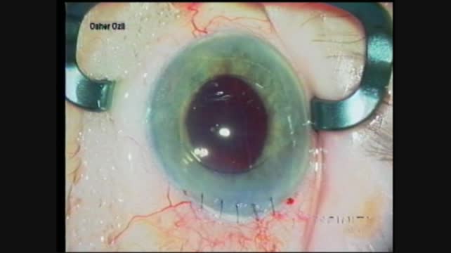 Anterior Chamber IOL