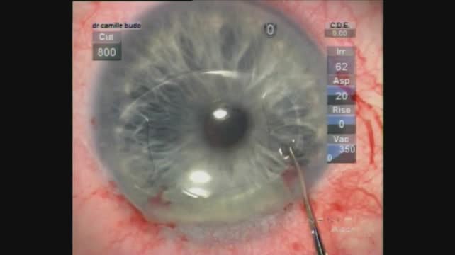 Enclavation: Anterior Iris