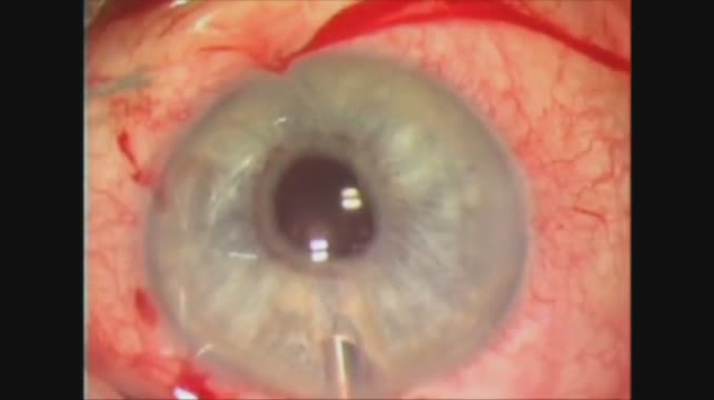 Enclavation: Posterior Iris