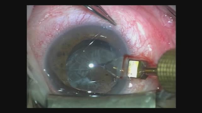 Iris Suture Fixation