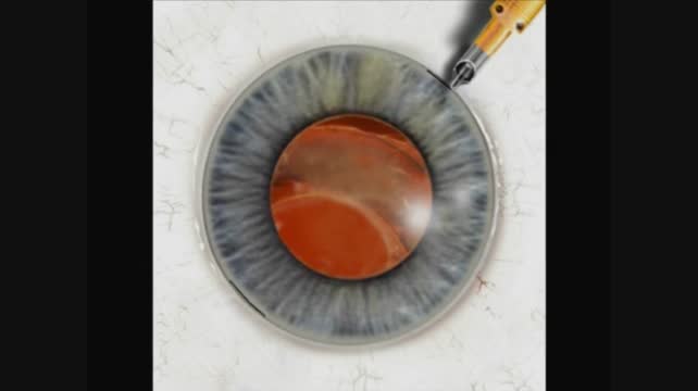 Sulcus Suture Fixation: Conjunctiva Sparing