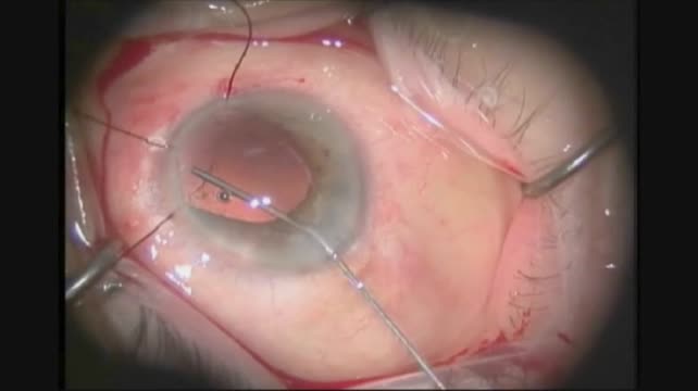 Sulcus Suture Fixation: Forceps Retrieval
