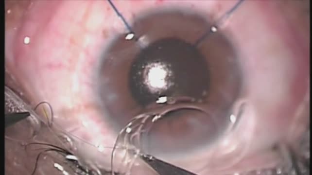 Sulcus Suture Fixation: Needle in Cartridge