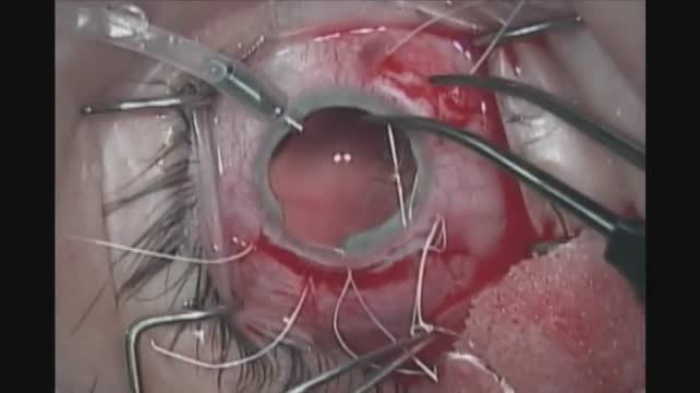 Sulcus Suture Fixation: Gore-Tex & Cowhitch