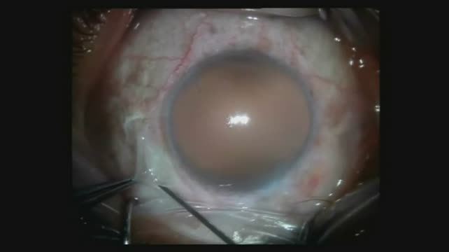 Sulcus Suture Fixation: Prosthetic Iris