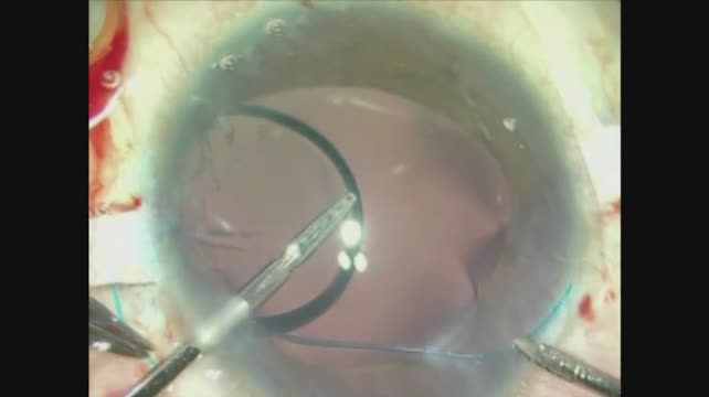 Intrascleral Glued IOL