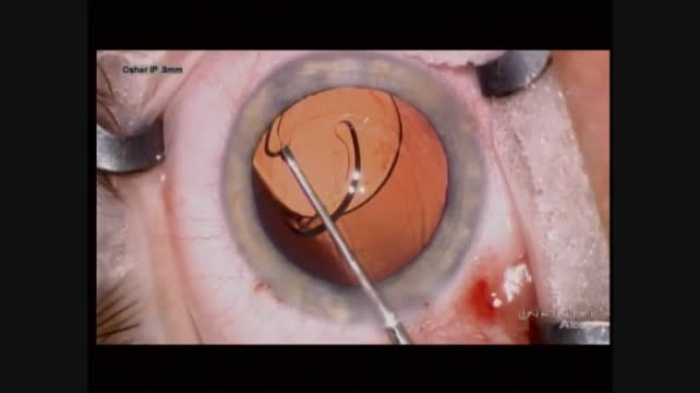 Insertion Damage with IOL Exchange