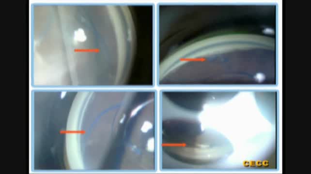 Anterior Chamber IOL