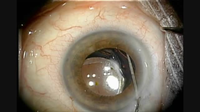 Sutured Iris Fixation