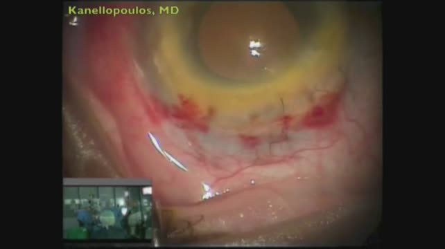 Posterior Iris Enclavation