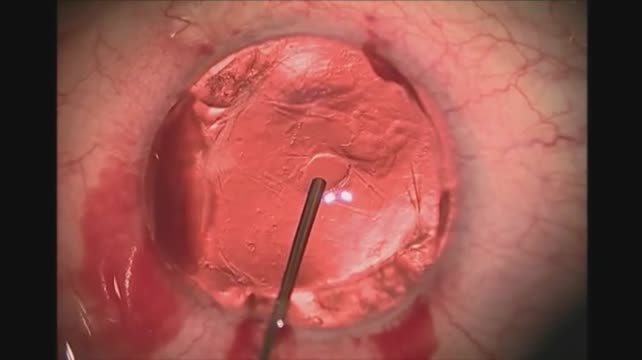 Capsular Fixation