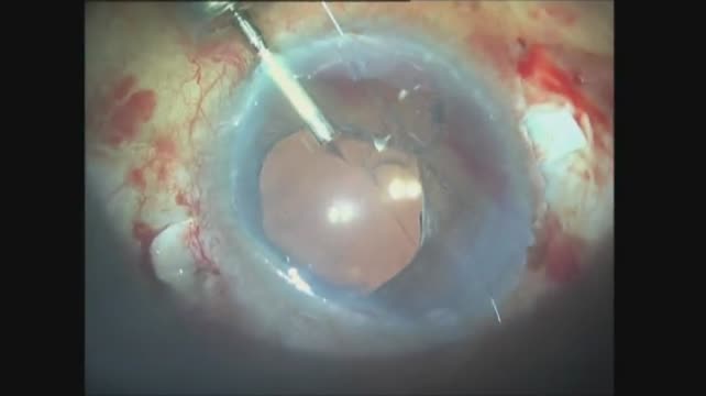 Scleral Tunnel for Glued IOL