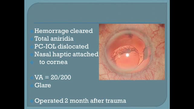Sutured Optic