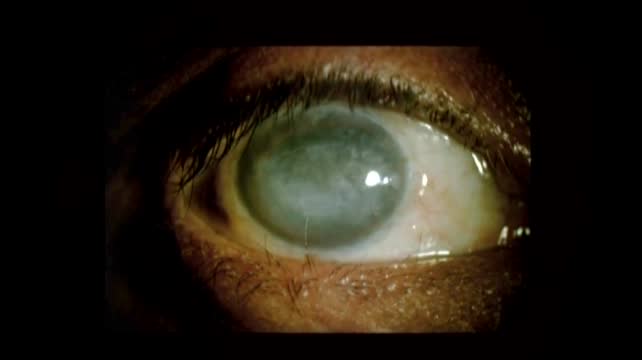 Corneal Opacification: No View 