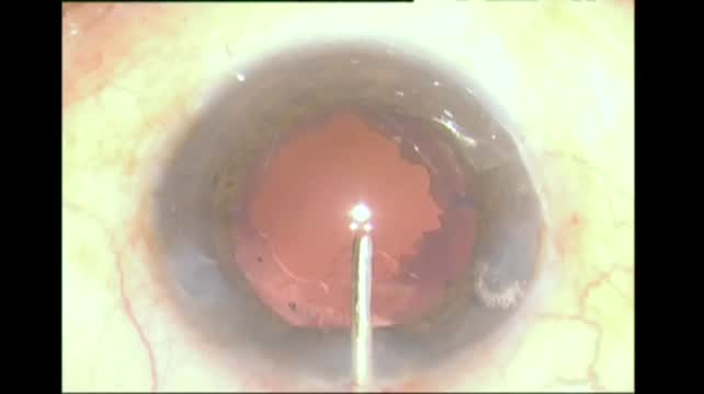 Impossible Capsulotomy 