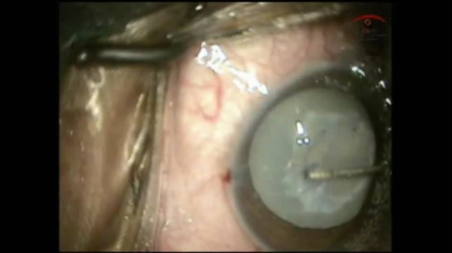 Capsular Fibrosis 