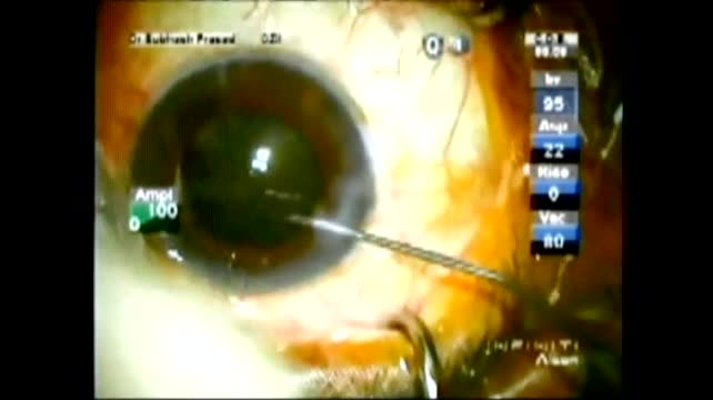 Hard Eye with Iris Prolapse 