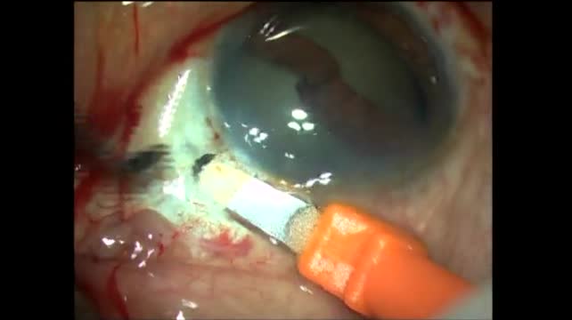 Iatrogenic Iridodialysis