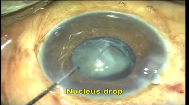 Dropped Nucleus