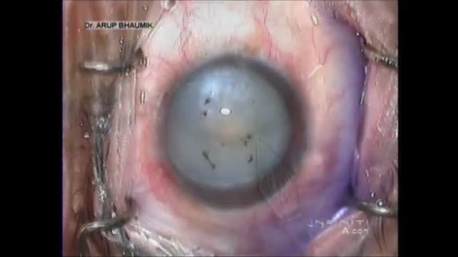 Torn Posterior Capsule