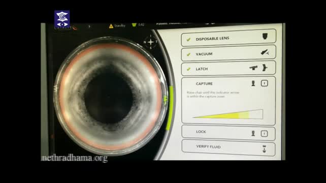 Posterior Polar Cataract 