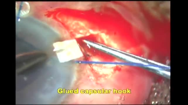 Innovative Device: Glued Capsular Hook