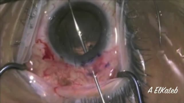 Iatrogenic Zonular Dialysis 