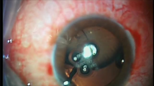 Massive Zonular Damage 