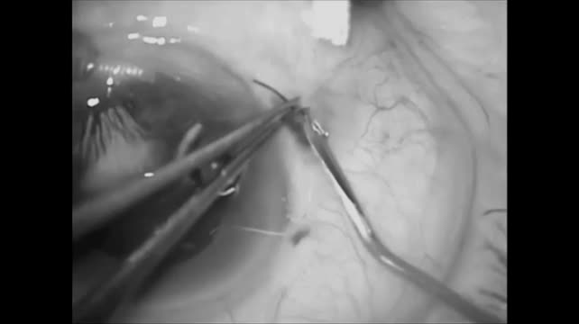 New IOL Design for Scleral Fixation