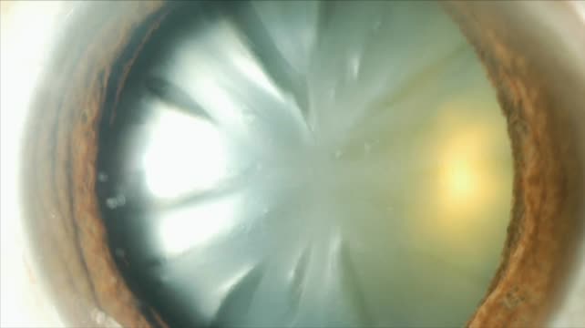 Opacification of IOL