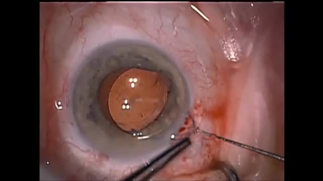 OPL Winning Team; Traumatic Cataract; Lying Down on the Job