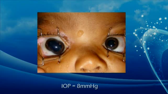 Double Crystalline Lens