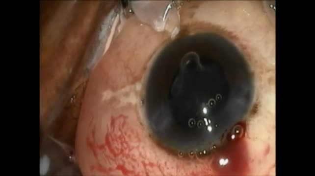 Posterior Capsular Cysts