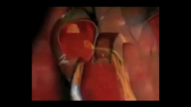 Pulsatile Herniation of the Posterior Capsule