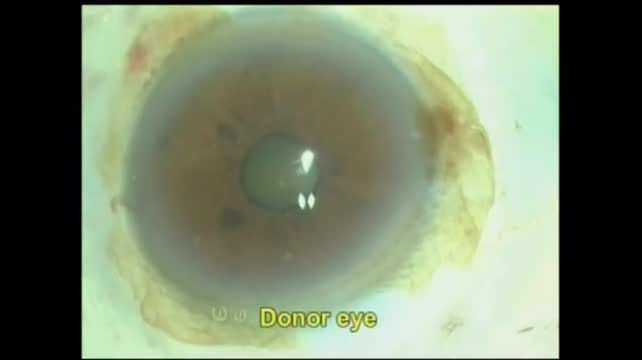 Anterior Segment Transplantation