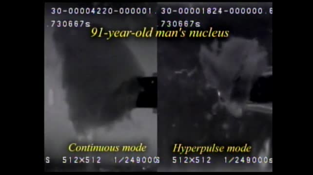 Ultra-High Speed Images of the Phaco Tip Under Different Power Modes (2005)