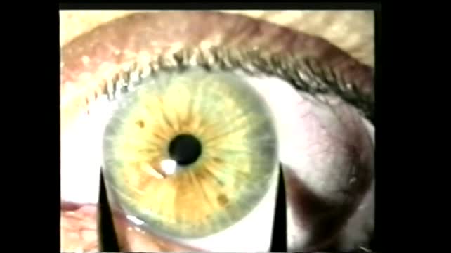 Importance of Proper ICL Vaulting (2000)