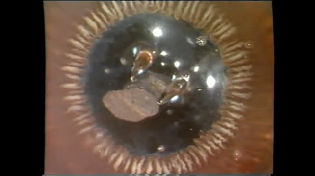 The Mature Cataract and its Sharp Edges: Fact or Fiction (1997)