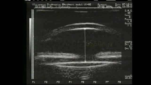 Accommodation in the Pseudophake (1998)