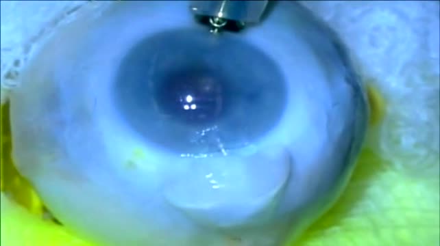 Minimally Invasive External Mini-Glaucoma Shunt (2011)